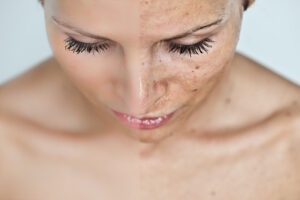 Hautverfärbungen im Gesicht – wie entstehen? Mein Kampf gegen Hautflecke